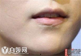 脸上的疤图片,探寻脸庞印记的深刻寓意